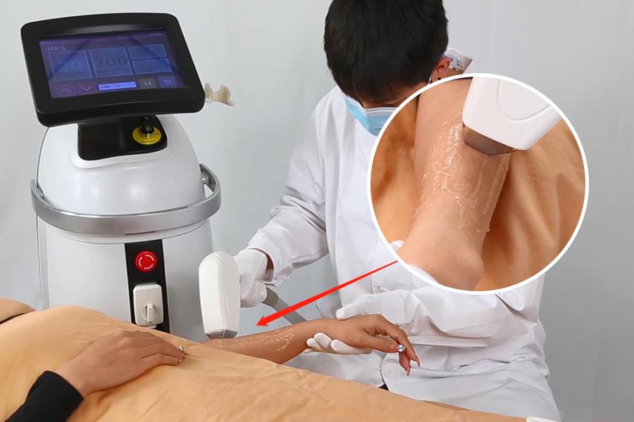 laser hair removal